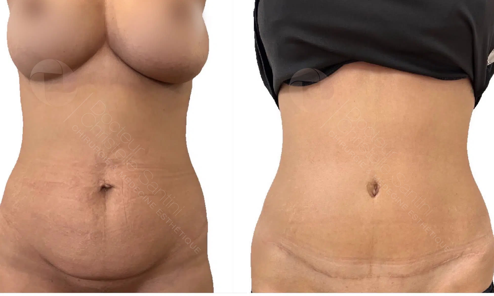 Abdominoplastie