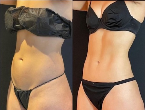 Liposuccion 360