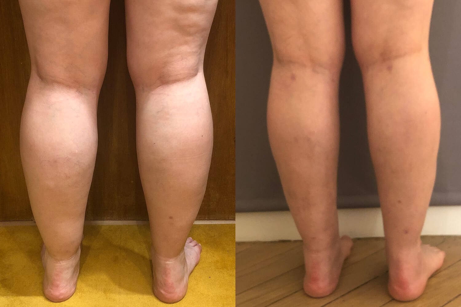 Chirurgie du Lipœdème