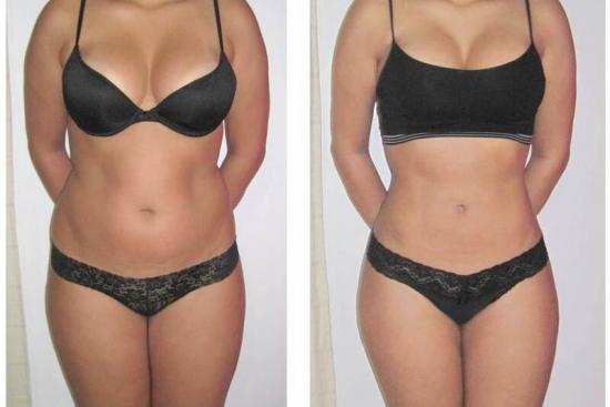 Liposuccion 360 HD