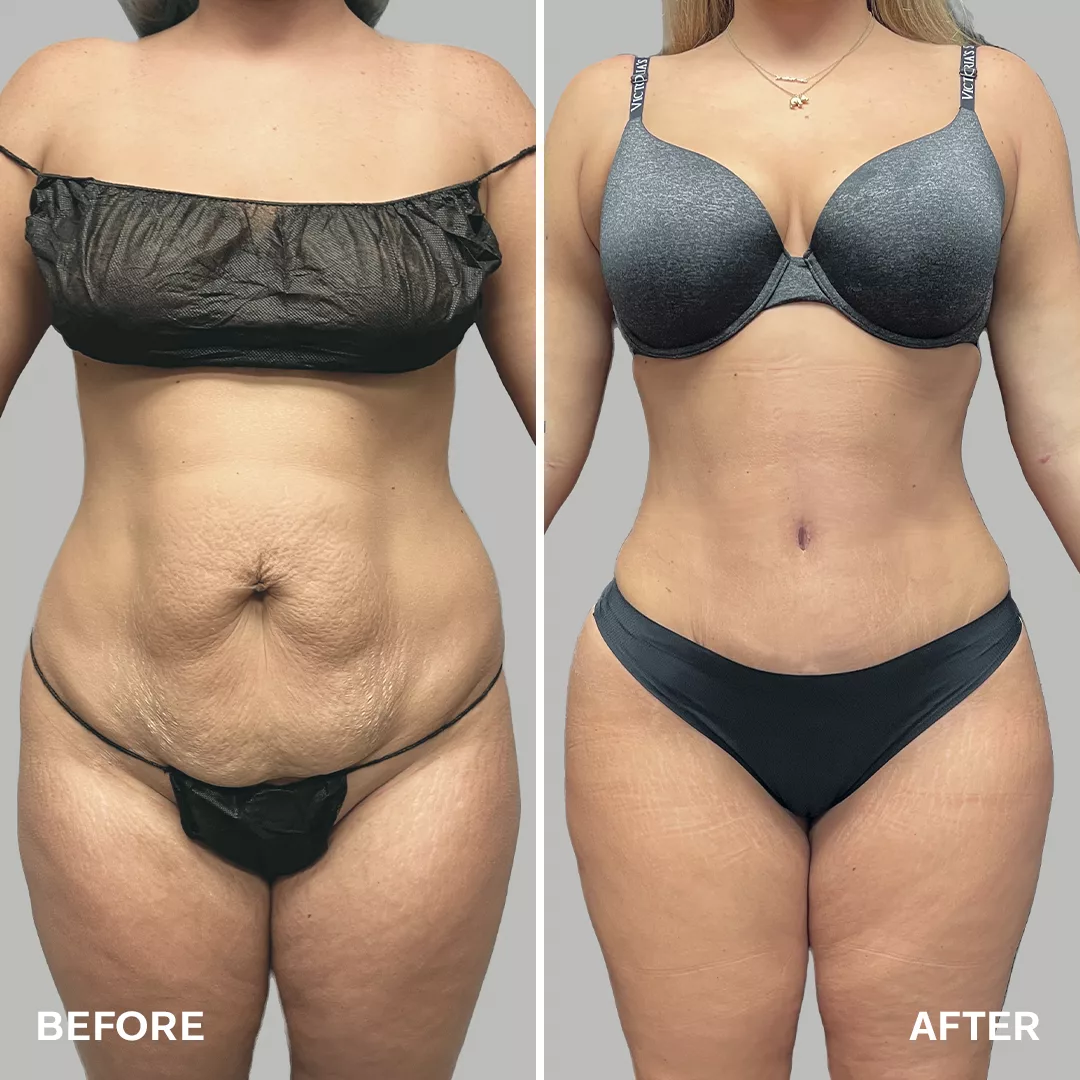 Mommy Makeover
