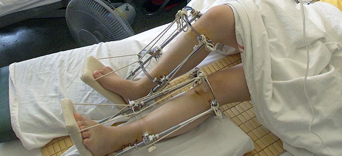 Chirurgie d'Allongement des Jambes