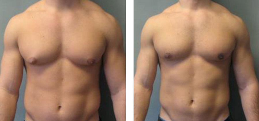 Poitrine masculine
