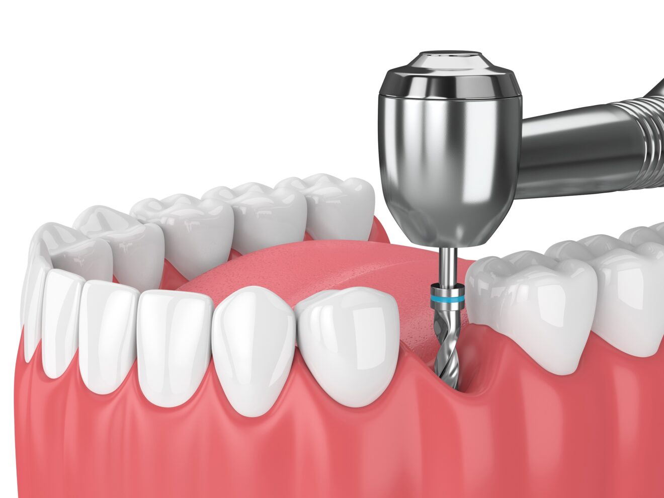 Implants Dentaires