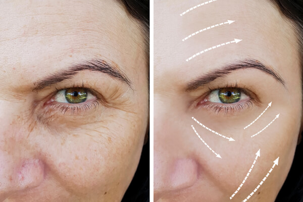 Lifting du visage