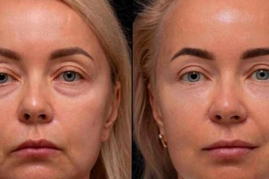 Lipofilling Visage