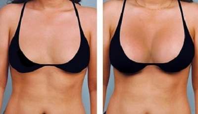 Lipofilling Mammaire