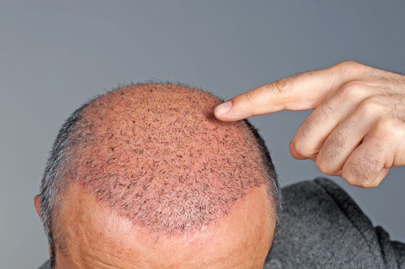 Greffe de cheveux