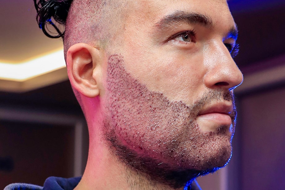 Greffe barbe & sourcils