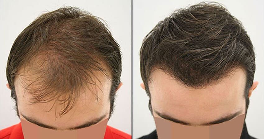 Greffe Neograft